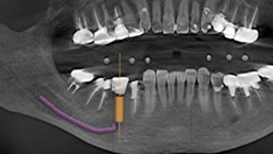4. 下顎管の位置を確認